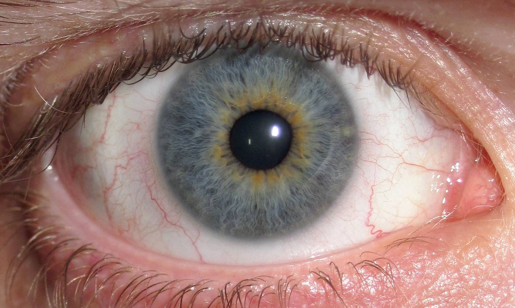 علاج عوامات العين