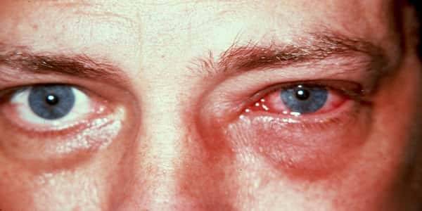 التهاب العين الفيروسي - يعنى 
